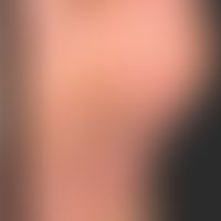 Keratoderma blennorrhagicum: Zirzinäre hyperkeratotische, teils pustulöse bzw. erosive Herde.&nbs...