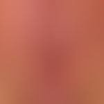 Lentigo of the mucous membrane: harmless, persistent, irregular and blurred, symptom-free, brown-...