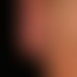 Mycosis fungoides follikulotrope: increasing, approximately 0.3 cm large, slightly itchy, yellowi...