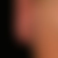 Folliculotropic Mycosis fungoides: progressive, localized, acne-like clinical picture that has ex...