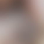 Melanom malignes akrolentiginöses: Auflichtmikroskopie, völlig unregelmäßige Pigmentverteilung mi...