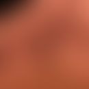 Melanoma, malignant, acrolentiginous: a slow-growing, previously asymptomatic hyperpigmentation t...