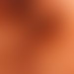 Melanom, malignes, akrolentiginöses: Auflichtmikroskopie;&nbsp;schlierige, strukturlose&nbsp;Pigm...