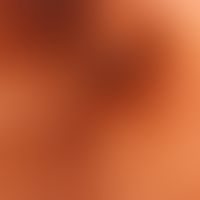 Melanoma, malignant, acrolentiginous: reflected light microscopy ; streaky, structureless pigment...