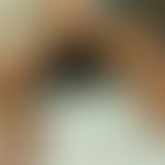 Nevus melanocytic congenital bathing suit type: large-area congenital melanocytic nevus with mult...