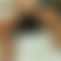 Nevus melanocytic congenital bathing suit type: large-area congenital melanocytic nevus with mult...