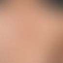 Notalgia paraesthetica:interval-like itching, also burning, blurredly limited hyperpigmentation, ...