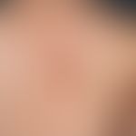 Notalgia paraesthetica:interval-like itching, also burning, blurredly limited hyperpigmentation, ...