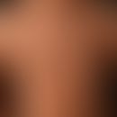 type i neurofibromatosis, peripheral type or classic cutaneous form. numerous smaller and larger ...