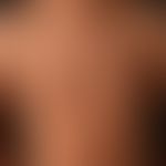 type i neurofibromatosis, peripheral type or classic cutaneous form. numerous smaller and larger ...
