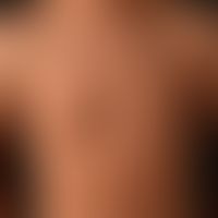 type i neurofibromatosis, peripheral type or classic cutaneous form. numerous smaller and larger ...