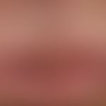 Lip carcinoma: Apparently from the skin of the lips (not from the lip red) spreading to the lip r...