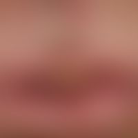 Lip carcinoma: Apparently from the skin of the lips (not from the lip red) spreading to the lip r...