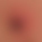 Tick bite: tick during the sucking act; pronounced collateral erythema (initial erythema chronicu...