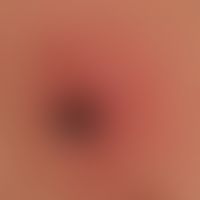 Zeckenstich:&nbsp; Zecke beim Saugakt. Ausgeprägtes kollaterales Erythem (initiales Erythema chro...