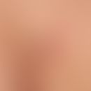 tick bite. tick during sucking. strong erythema around the bite. suspected initial erythema chron...