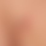 tick bite. tick during sucking. strong erythema around the bite. suspected initial erythema chron...