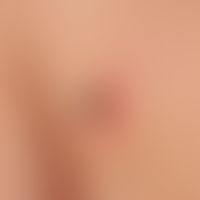 Zeckenstich.&nbsp; Zecke beim Saugakt. Kräftiges Erythem um die Stichstelle. Verdacht auf initial...