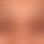 Xanthelasma: die&nbsp;bestehenden Hautläsionen entwickelten sich allmählich innerhalb der vergang...