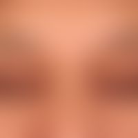 Xanthelasma. the existing skin lesions developed gradually over the past two years. about 1.0 cm ...