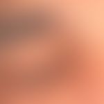 Xanthelasma palpebrarum: 2 kleinere symptomlose gelbe Papeln. Im Augen-Nasenwinkel findet sich zu...
