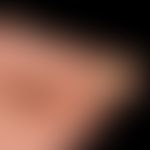 Verrucae vulgares: flächiges Warzenbeet mit subungualer Infiltration. Langsames peripheres Fortsc...