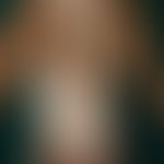 Vitiligo: generalized vitiligo in a young Ethiopian. sharply defined, almost symmetrically arrang...
