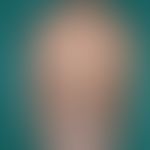 Pityriasis rosea in dark skin. A few weeks old, slightly itchy, bran-like scaly exanthema in a yo...