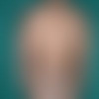 Pityriasis rosea in dunkler Haut:&nbsp;wenige Wochen bestehendes, wenig juckendes, kleieförmig sc...