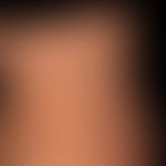 Pityriasis rosea: Characteristic exanthema that exists for a few weeks, only slightly itchy, and ...