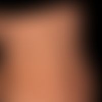 Pityriasis rosea: charakteristisches wenig Wochen bestehendes, nur gering juckendes Exanthem. Aus...