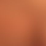 Parapsorisis en petites plaques: completely symptom-free red (hardly palpable), slightly scaly pl...