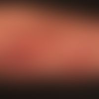 Dermatitis herpetiformis: multiple, disseminated, eminently chronic, itchy, prickly, scratched ex...
