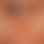 Syringomas of the eyelids: 0.1-0.2 cm large, isolated and aggregated, symptomless, firm papules i...