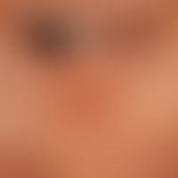 Syringomas of the eyelids: 0.1-0.2 cm large, isolated and aggregated, symptomless, firm papules i...