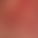 Rowell`s Syndrom: Detailausschnitt.
