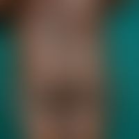 Psoriasis vulgaris: 12-year-old Ethiopian boy, non-pretreated chronic inpatient plaque-type psori...