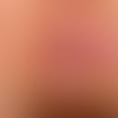 AIN: perianal lokalisierte, wenig sympotmatische, &nbsp;flächige, weißlich-erosive Plaque bei 3 U...