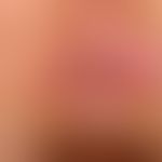 AIN: perianal lokalisierte, wenig sympotmatische, &nbsp;flächige, weißlich-erosive Plaque bei 3 U...