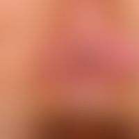 AIN: perianal lokalisierte, wenig sympotmatische, &nbsp;flächige, weißlich-erosive Plaque bei 3 U...