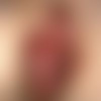 Anal carcinoma: ulcerated lump that has existed for years and is apparently without shcmercion.
