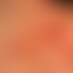 Cheiropompholyx: Detailaufnahme.
