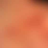 Cheiropompholyx: Detailaufnahme.
