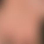 Tinea manuum. Seit längerem besteht bei dem 50-jährigen Patienten diese groblamellär schuppende, ...