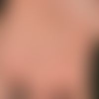 Tinea manuum. Seit längerem besteht bei dem 50-jährigen Patienten diese groblamellär schuppende, ...