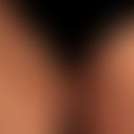 Extrapulmonale Sarkoidose mit (ausgedehntem) Befall von Haut (D86.3) und inguinalen Lymphknoten (...