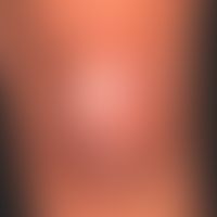 Scar sarcoidosis: Since about 9 months development of completely symptom-free plaque in an old ir...
