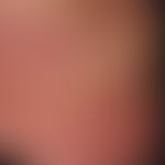Zellulitis eosinophile: ungewöhnlich ausgedehnter Hautbefund. Seit mehereren Wochen bestehendes K...