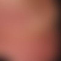 Cellulitis eosinophile: unusually extensive skin findings, with a clinical picture that has exist...