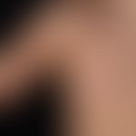 Cutis marmorata teleangiectatica congenita: unilateral, reinforced reticular vascular drawing pre...
